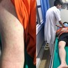 Nam thanh niên sốc phản vệ nguy kịch vì bắt con mối để nấu ăn