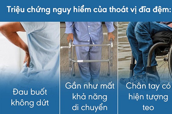 Thoát vị đĩa đệm: Nguyên nhân, triệu chứng và cách chữa ...