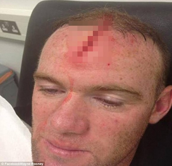 Cận cảnh vết thương kinh hoàng của Rooney ảnh 1