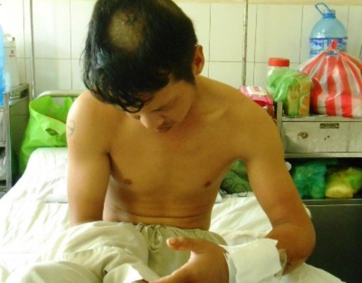 Bị giang hồ truy sát nhầm, nam công nhân gần đứt lìa tay ảnh 1