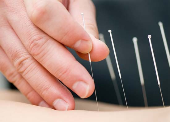 Châm cứu giúp giảm mức độ stress ảnh 1