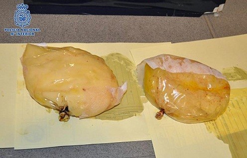 Cấy "độn ngực" bằng 1,3kg cocaine ảnh 1