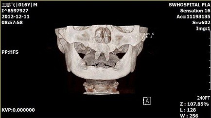 Cậu bé mọc răng như ma cà rồng ảnh 2