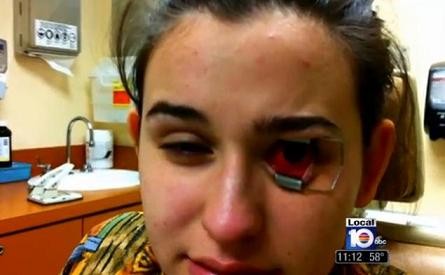 Cô gái 18 tuổi suýt bị mù mắt vì kính áp tròng ảnh 2