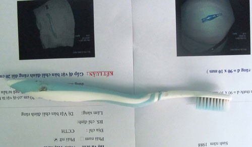 Nuốt phải bàn chải đánh răng vì mải buôn điện thoại ảnh 1