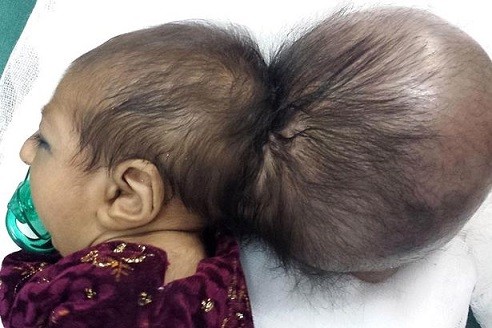 Bé gái hai đầu được phẫu thuật thành công ảnh 1