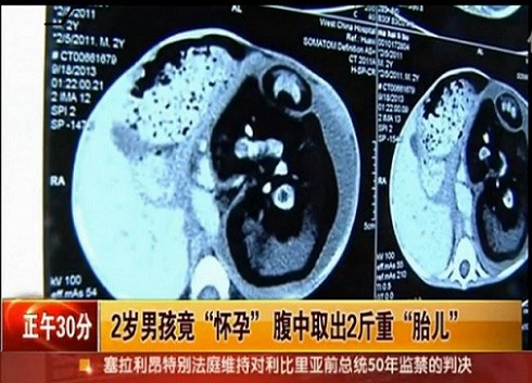 Bé trai 2 tuổi “đẻ” ra người anh em sinh đôi ảnh 2