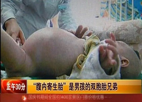 Bé trai 2 tuổi “đẻ” ra người anh em sinh đôi ảnh 1