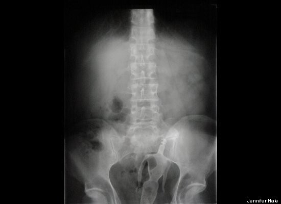 Bộ sưu tập ảnh các "vật thể lạ" trong bụng ảnh 2