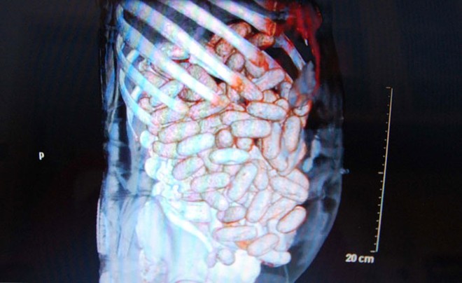 Kinh hoàng người đàn ông chứa 2 kg cocaine trong bụng ảnh 1