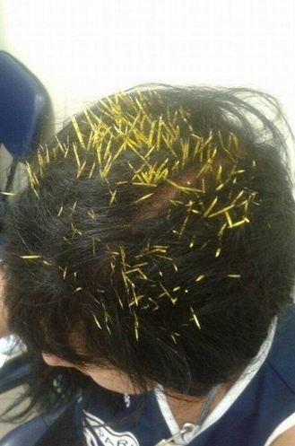 Nhập viện vì bị 200 gai nhím cắm vào đầu ảnh 1