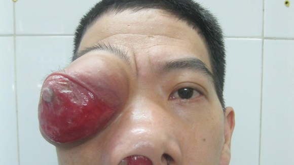 9 năm sống với khối u kỳ quái ảnh 1