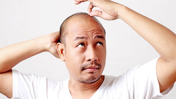 Hói đầu làm tăng nguy cơ bệnh thần kinh nghiêm trọng ảnh 1