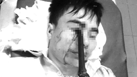 Phẫu thuật thành công cho người cầm ô đi xe bị cán gương đâm xuyên hốc mắt ảnh 1