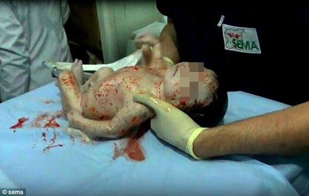 Giây phút cứu sống em bé bị mảnh bom găm vào trán ngay trong bụng mẹ ảnh 1