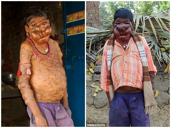 Cậu bé Ấn Độ khốn khổ vì bị hàng trăm khối u nổi trên cơ thể ảnh 2