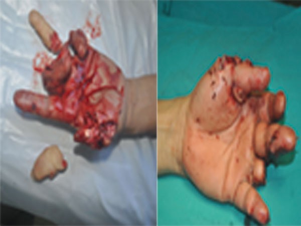 Nối ngón tay bằng kỹ thuật vi phẫu ảnh 1