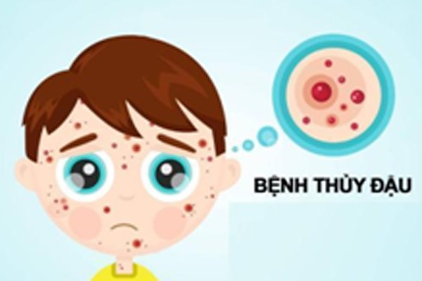 Bệnh ngoài da do virus: sởi, thủy đậu, tay chân miệng,… và cách điều trị ảnh 3
