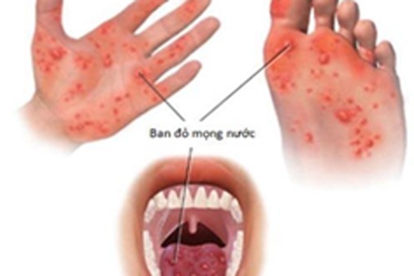 Bệnh ngoài da do virus: sởi, thủy đậu, tay chân miệng,… và cách điều trị ảnh 4