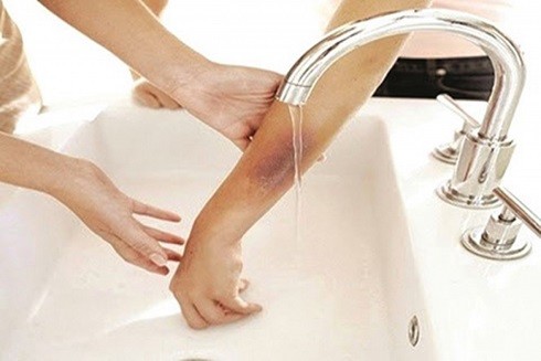 Nguyên nhân và hậu quả của axit tàn phá cơ thể gây nguy hiểm nghiêm trọng ảnh 6