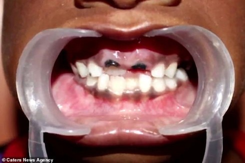 Ớn lạnh cảnh 526 chiếc răng mọc thành chùm trong miệng cậu bé Ấn Độ ảnh 2
