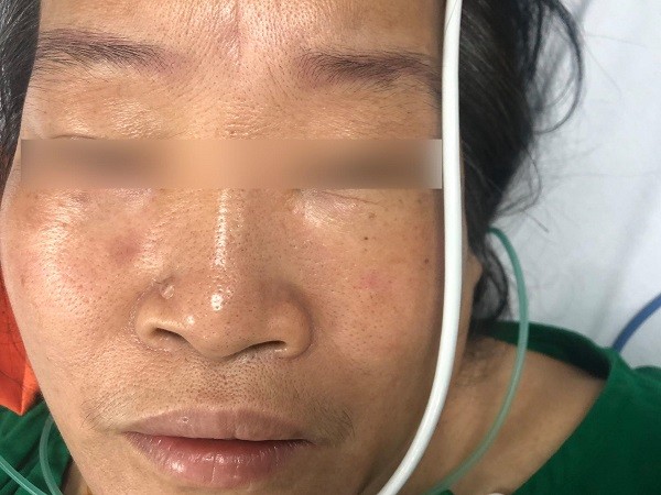 Bị ong lạ đốt, nữ bệnh nhân ở Hà Nội nhồi máu cơ tim cấp, ngừng tuần hoàn ảnh 1