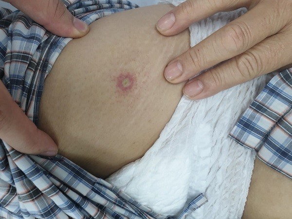 Bị ong lạ đốt, nữ bệnh nhân ở Hà Nội nhồi máu cơ tim cấp, ngừng tuần hoàn ảnh 2