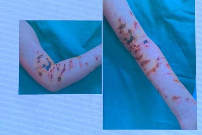 Sau chuyến tắm biển Hạ Long, bé trai 10 tuổi bị sứa đốt phải nhập viện với chằng chịt vết thương ảnh 1