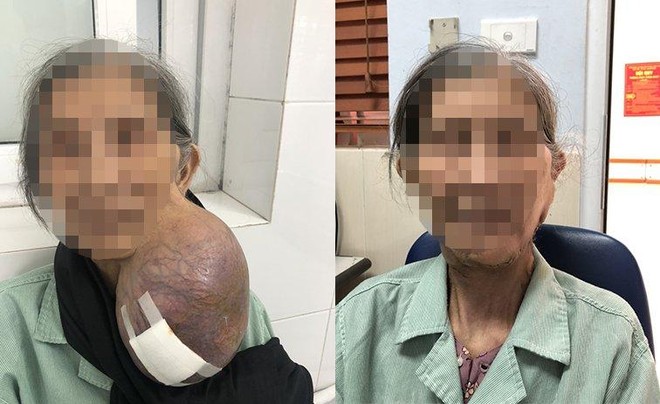Cụ bà đeo khối u khổng lồ làm biến dạng khuôn mặt nhưng 40 năm mới chịu đi khám lần đầu ảnh 1