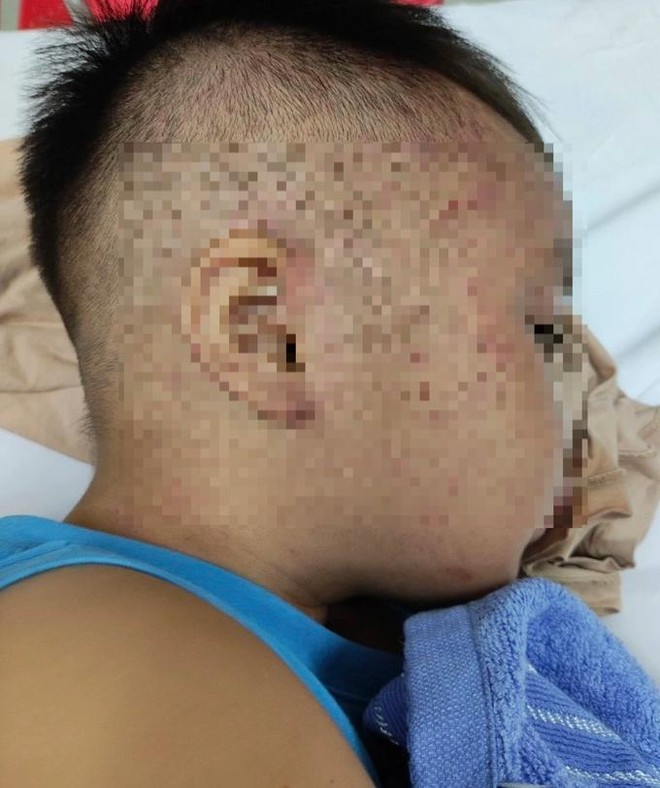 Bé trai 3,5 tuổi nghi bị bạo hành ở Hà Nam phải nhập viện cấp cứu, đã qua nguy kịch ảnh 1