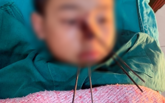 Bé trai 11 tuổi bị 4 mũi tên sắt từ nỏ tự chế bắn găm sâu vào vùng mũi ảnh 1