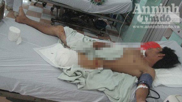 Kinh hoàng: Một người bị máy xay đá lạnh nghiến nát chân ảnh 1