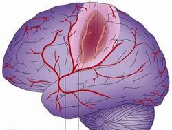 Thường thức về tai biến mạch máu não ảnh 3