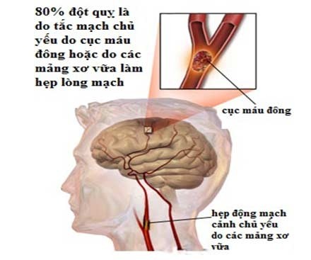 Thường thức về tai biến mạch máu não ảnh 4