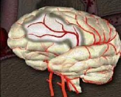 Thường thức về tai biến mạch máu não ảnh 2