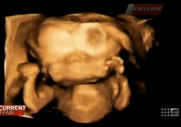  Bào thai có 2 khuôn mặt và 2 bộ não dính liền ảnh 3