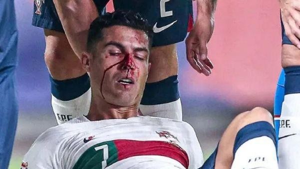 Ronaldo mặt đầm đìa máu trong chiến thắng của ĐT Bồ Đào Nha ảnh 2